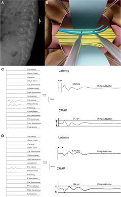 Quantitative identification of ventral/dorsal nerves through intraoperative neurophysiological monitoring by supervised machine learning